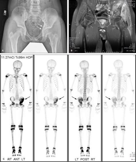 Familiarity with the radiographic appearance of free flaps such as the iliac crest is necessary for the postoperative evaluation of patients after mandibular, maxillary, or palatal reconstructions because it allows radiologists to properly monitor and. . Iliac bone cancer treatment